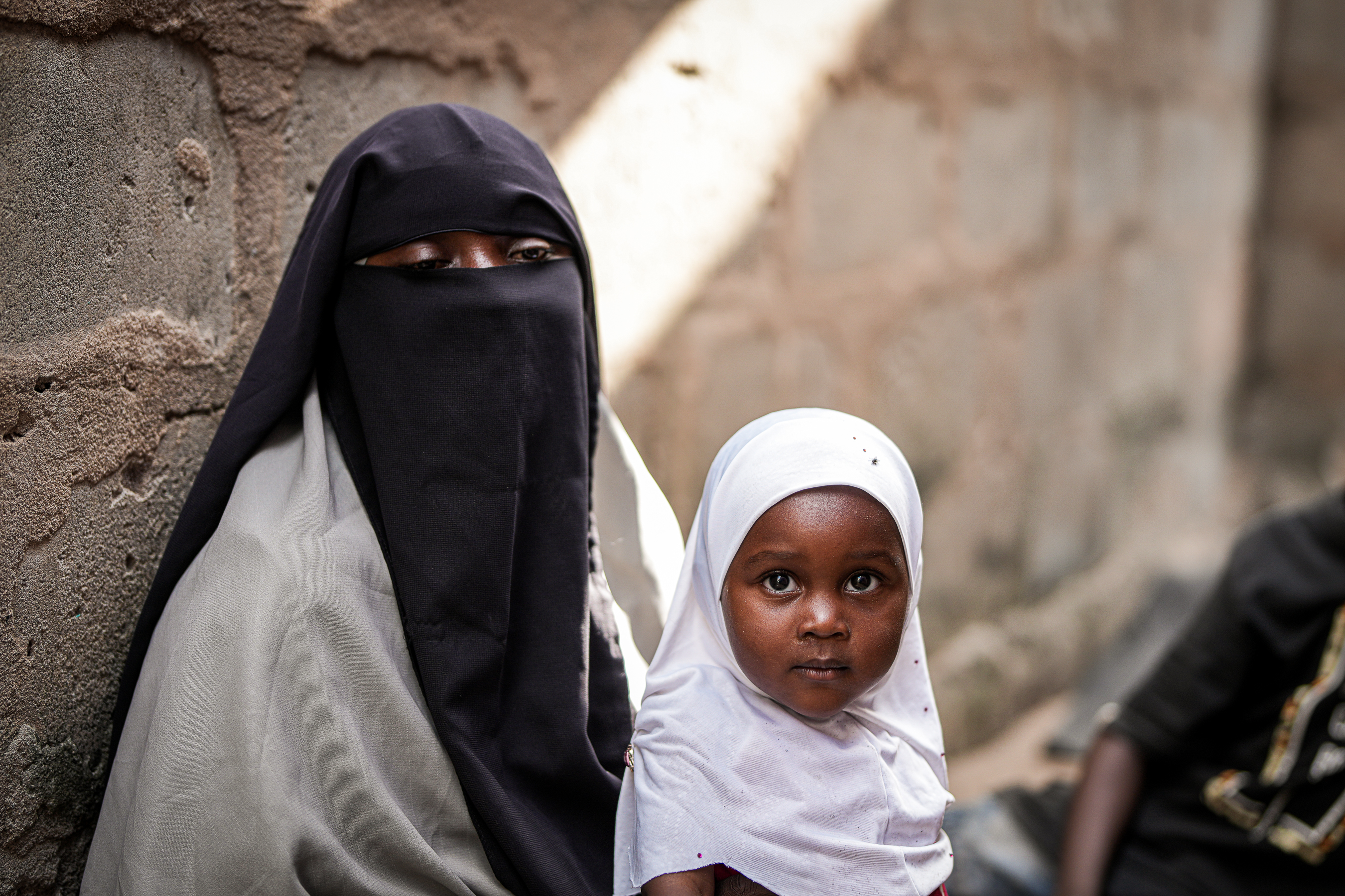 Baby affected by malnutrition